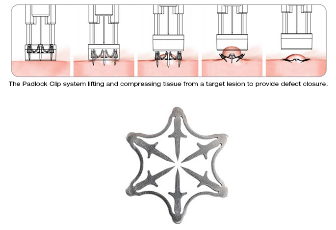 Padlock Clip® Defect Closure System